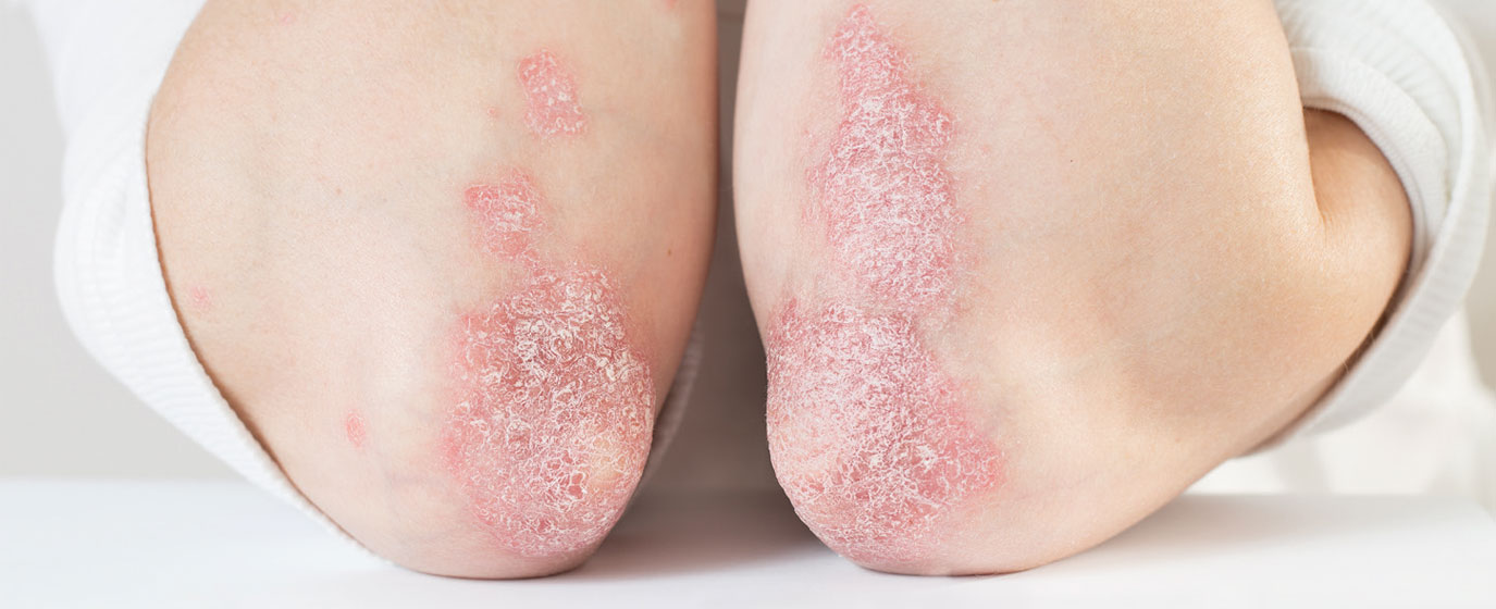 Ellenbogen mit Psoriasis bzw. Schuppenflechte
